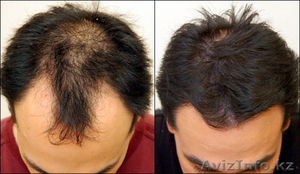 Kirkland 5% Minoxidil, 60мл. Для восстановления волос (Миноксидил) - Изображение #1, Объявление #1204336